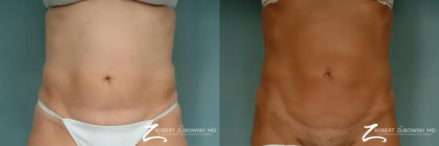 Liposuction: Patient 33 - Before and After  