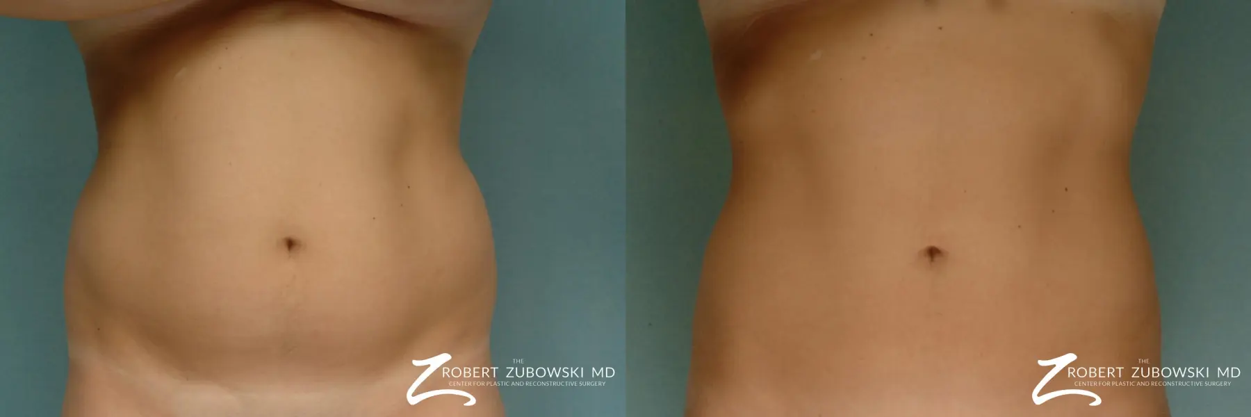 Liposuction: Patient 16 - Before and After  