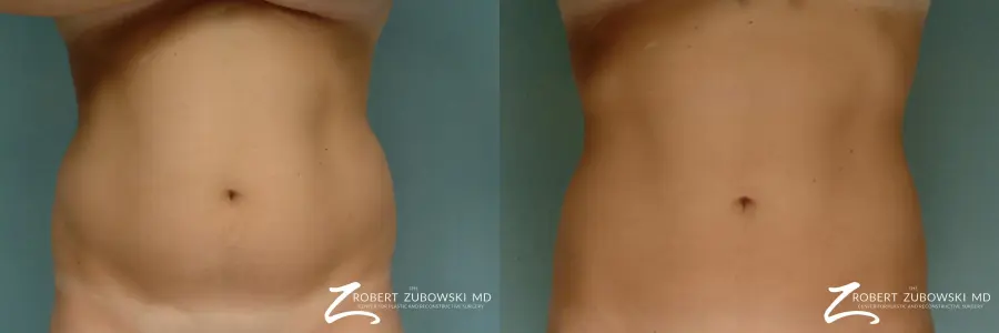 Liposuction: Patient 16 - Before and After 1