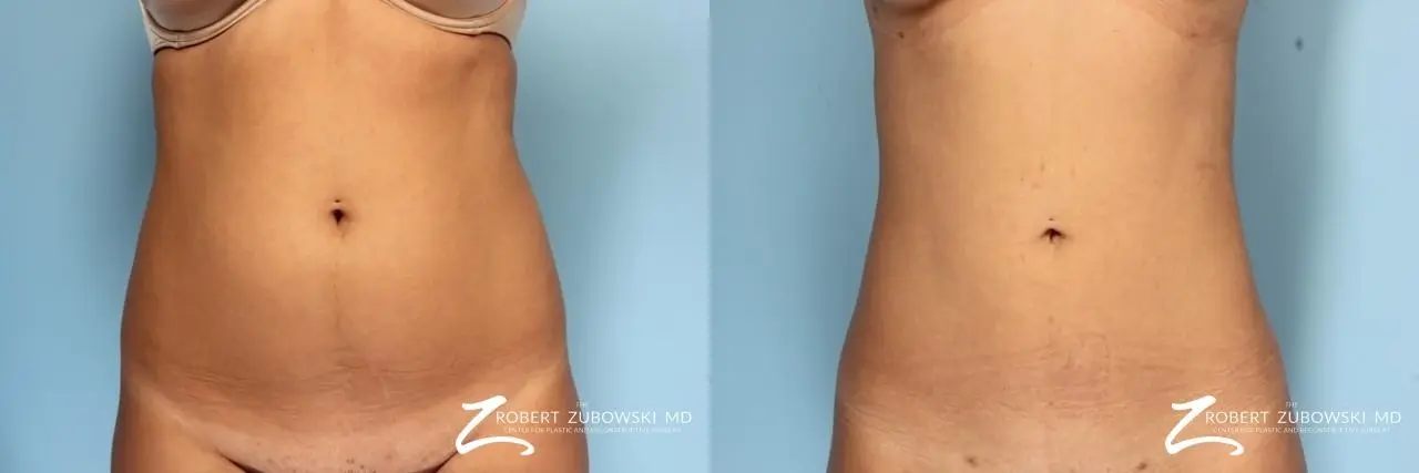 Liposuction: Patient 1 - Before and After  