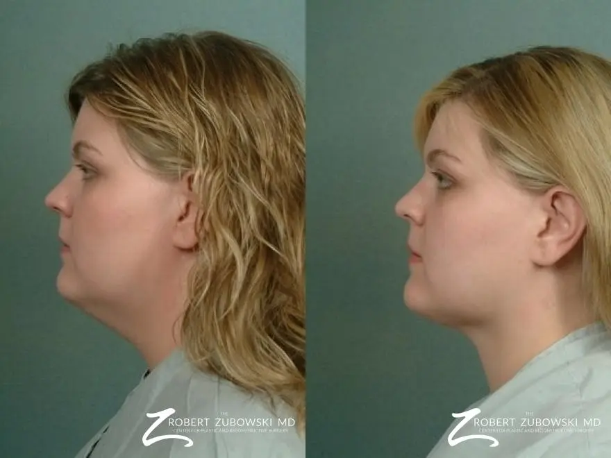 Liposuction: Patient 45 - Before and After 2
