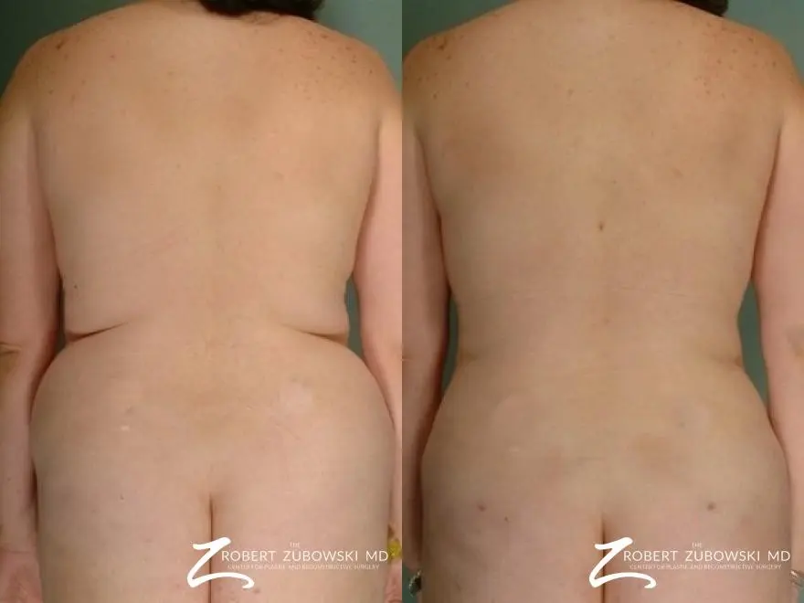 Liposuction: Patient 38 - Before and After  