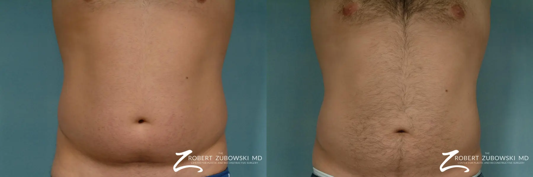 Liposuction: Patient 19 - Before and After 1