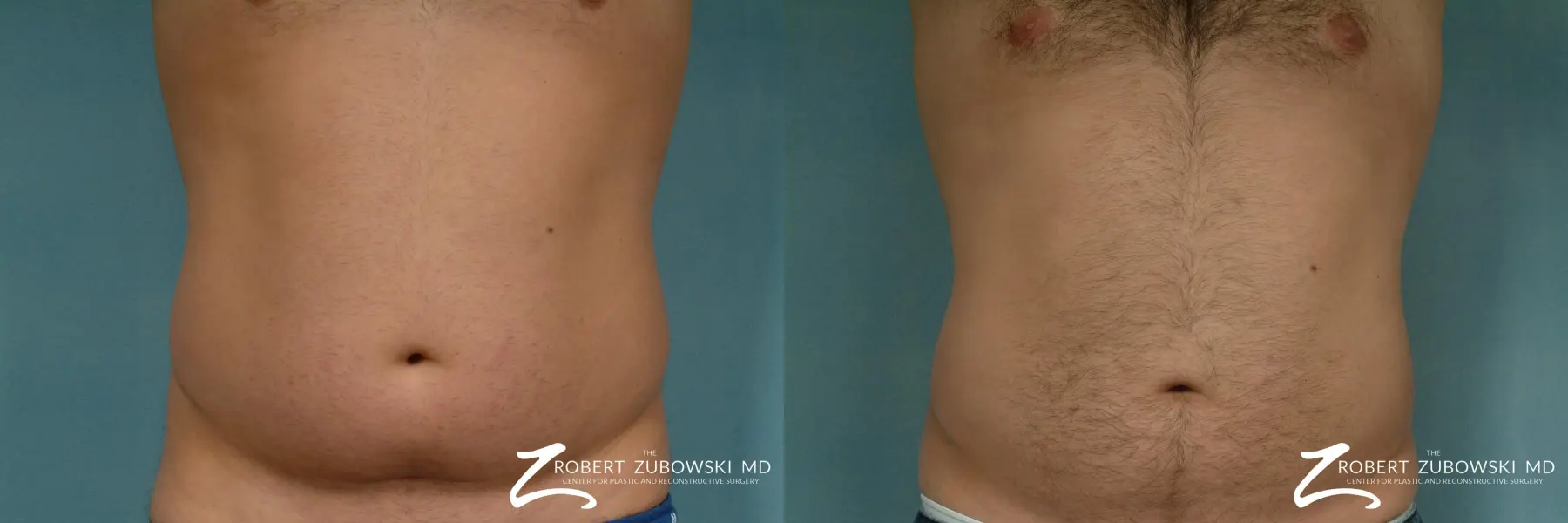 Liposuction: Patient 19 - Before and After  