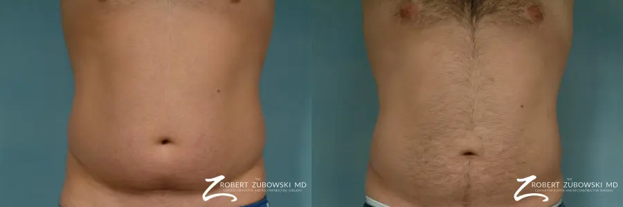 Liposuction: Patient 30 - Before and After  