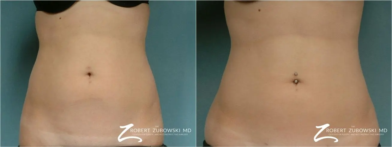 Liposuction: Patient 33 - Before and After  