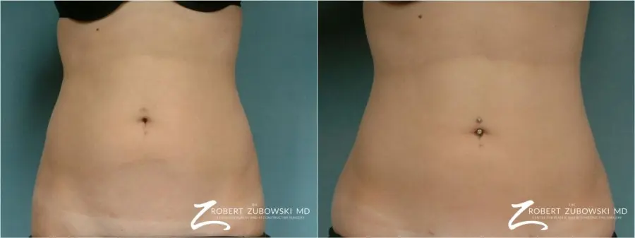 Liposuction: Patient 39 - Before and After  