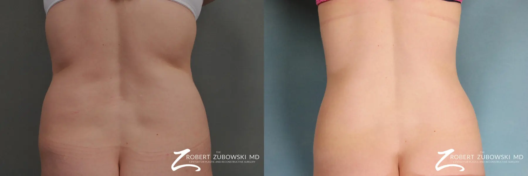 Liposuction: Patient 5 - Before and After  