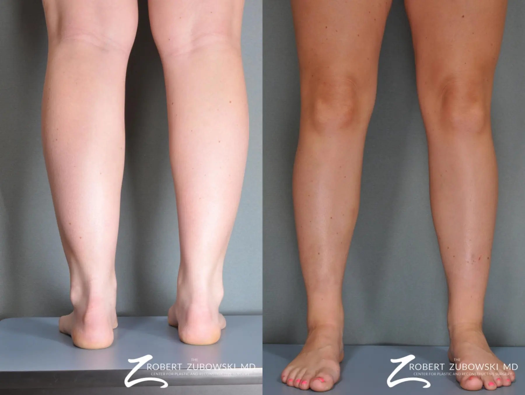 Liposuction: Patient 37 - Before and After 2