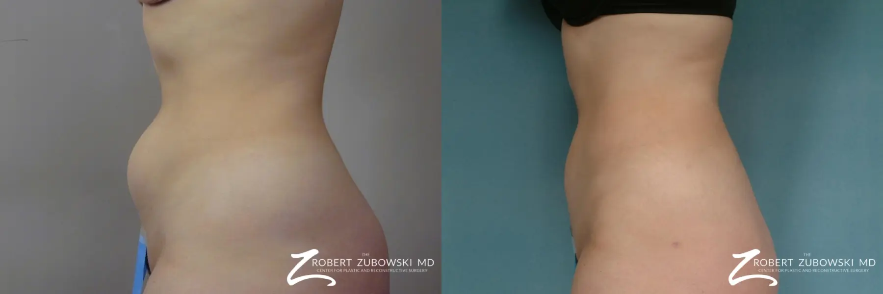 Liposuction: Patient 48 - Before and After 4
