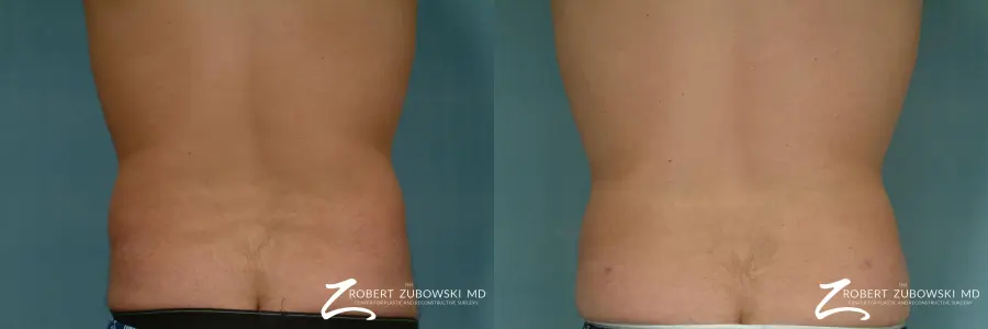 Liposuction: Patient 19 - Before and After 2