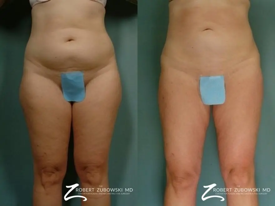 Liposuction: Patient 46 - Before and After 1