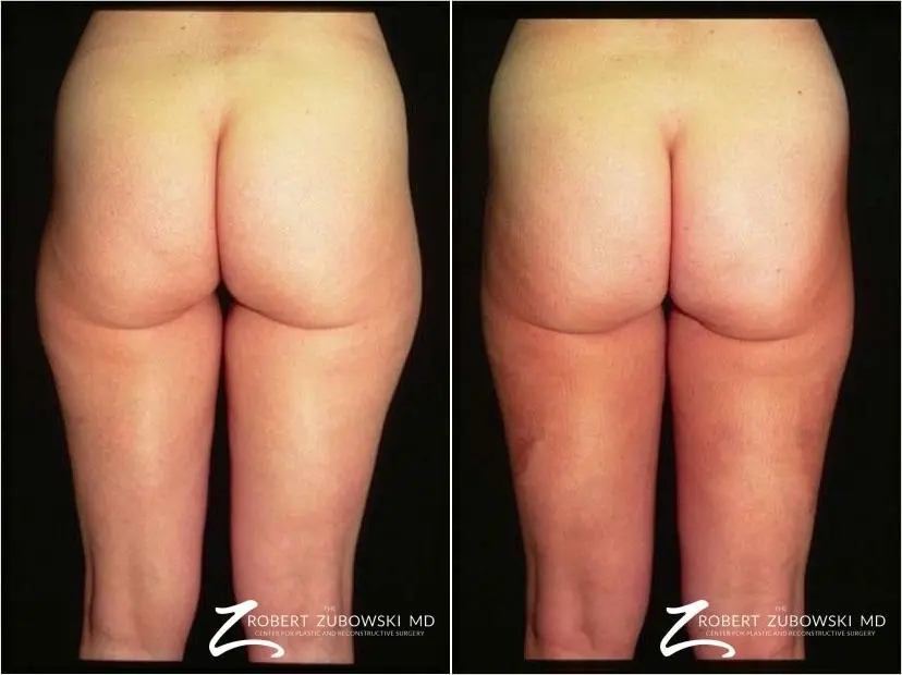 Liposuction: Patient 40 - Before and After  