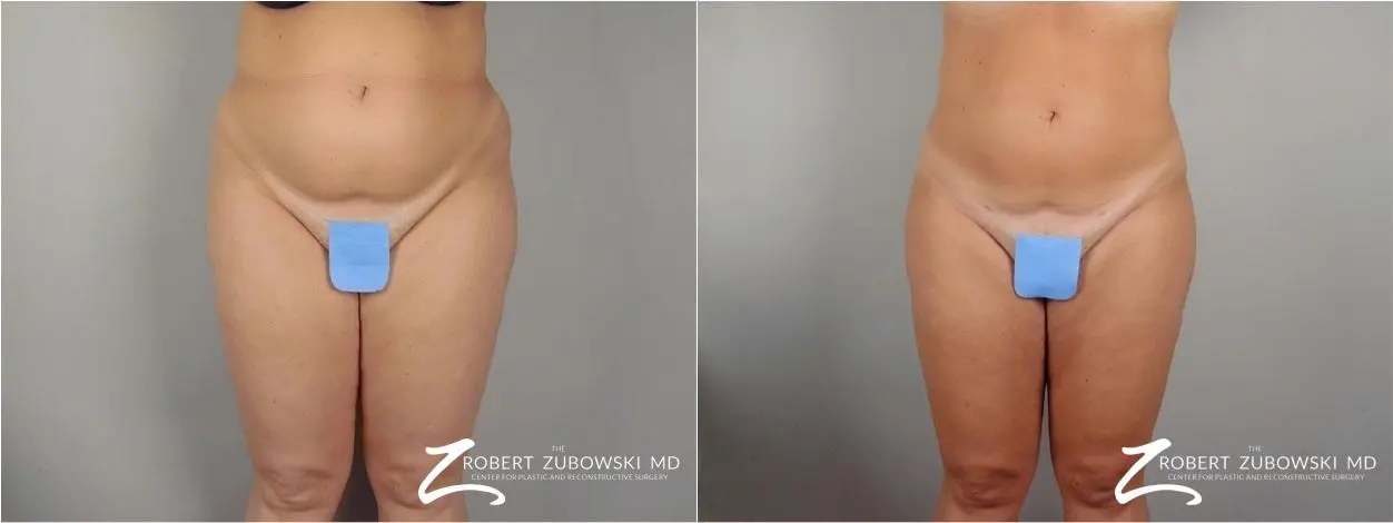Liposuction: Patient 32 - Before and After  
