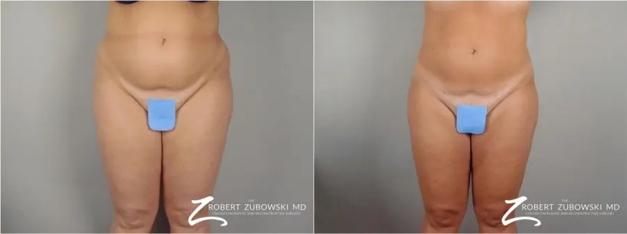 Liposuction: Patient 32 - Before and After 1