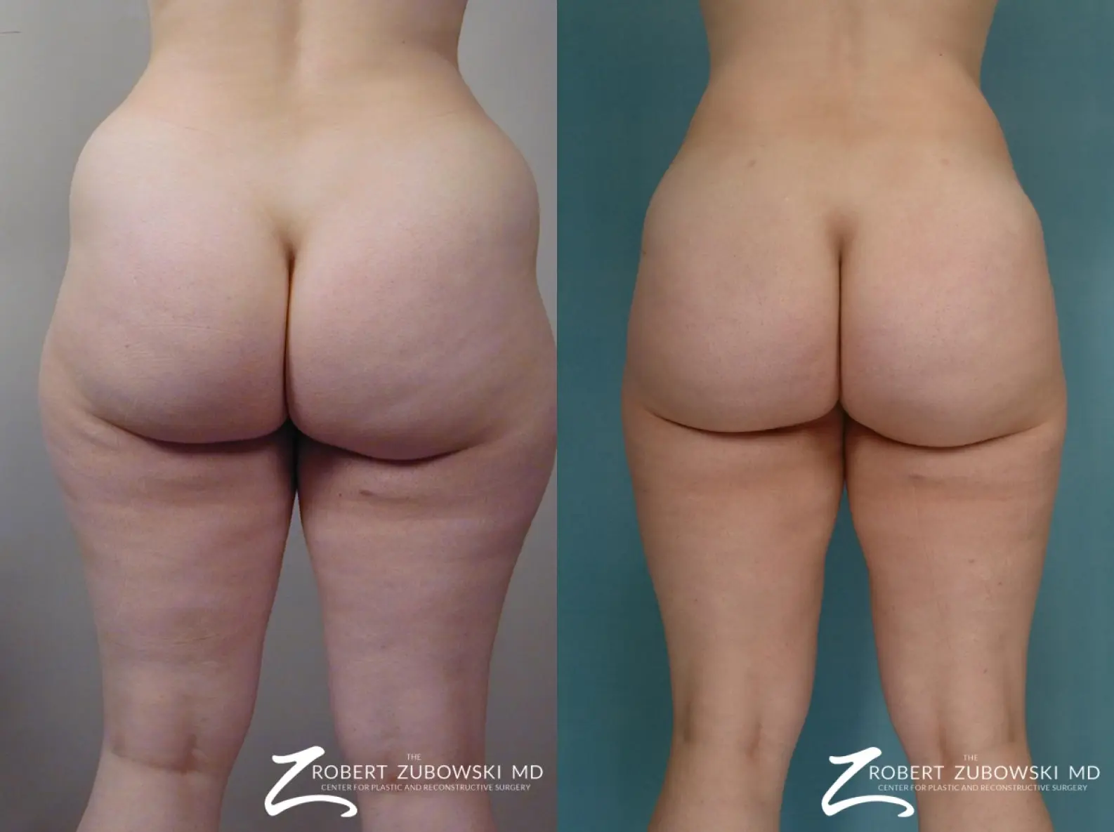 Liposuction: Patient 48 - Before and After 5