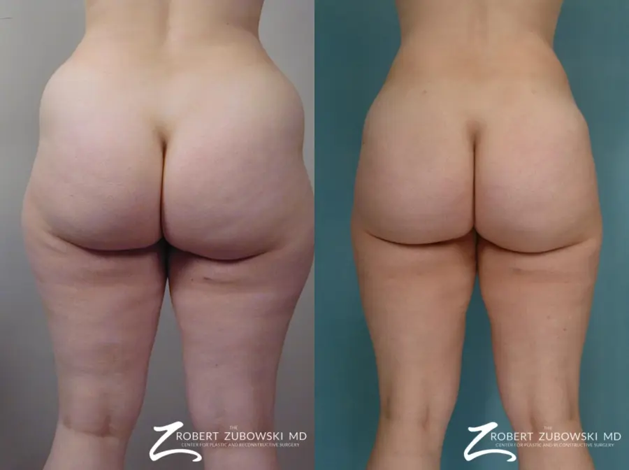 Liposuction: Patient 48 - Before and After 5