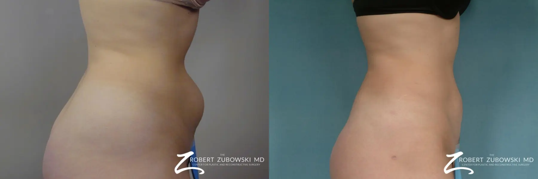 Liposuction: Patient 48 - Before and After 3