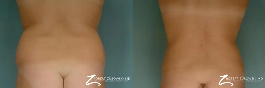 Liposuction: Patient 16 - Before and After 3