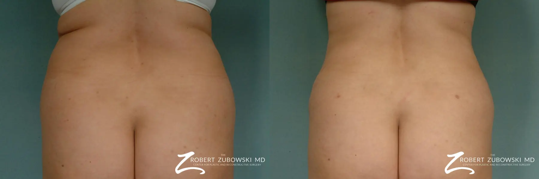 Liposuction: Patient 17 - Before and After  