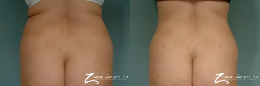 Liposuction: Patient 27 - Before and After  