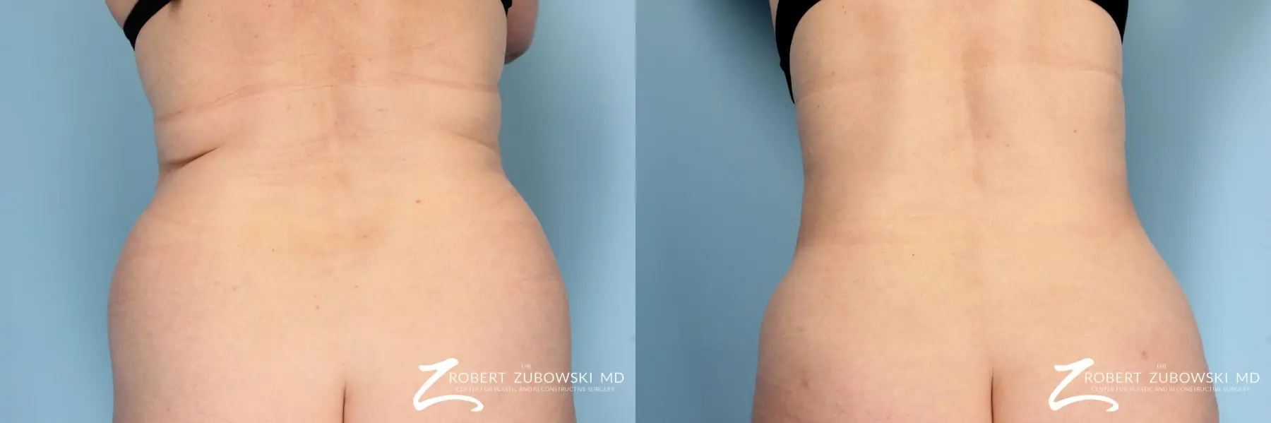 Liposuction: Patient 9 - Before and After  