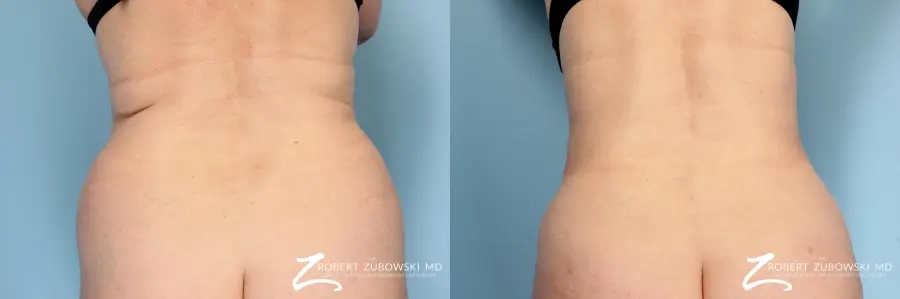 Liposuction: Patient 14 - Before and After  