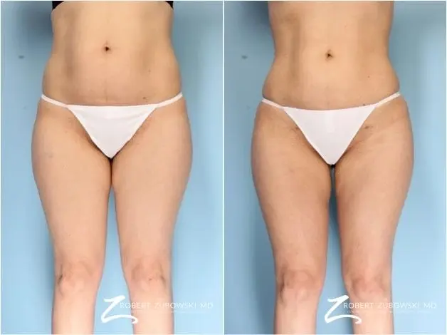 Liposuction: Patient 39 - Before and After  