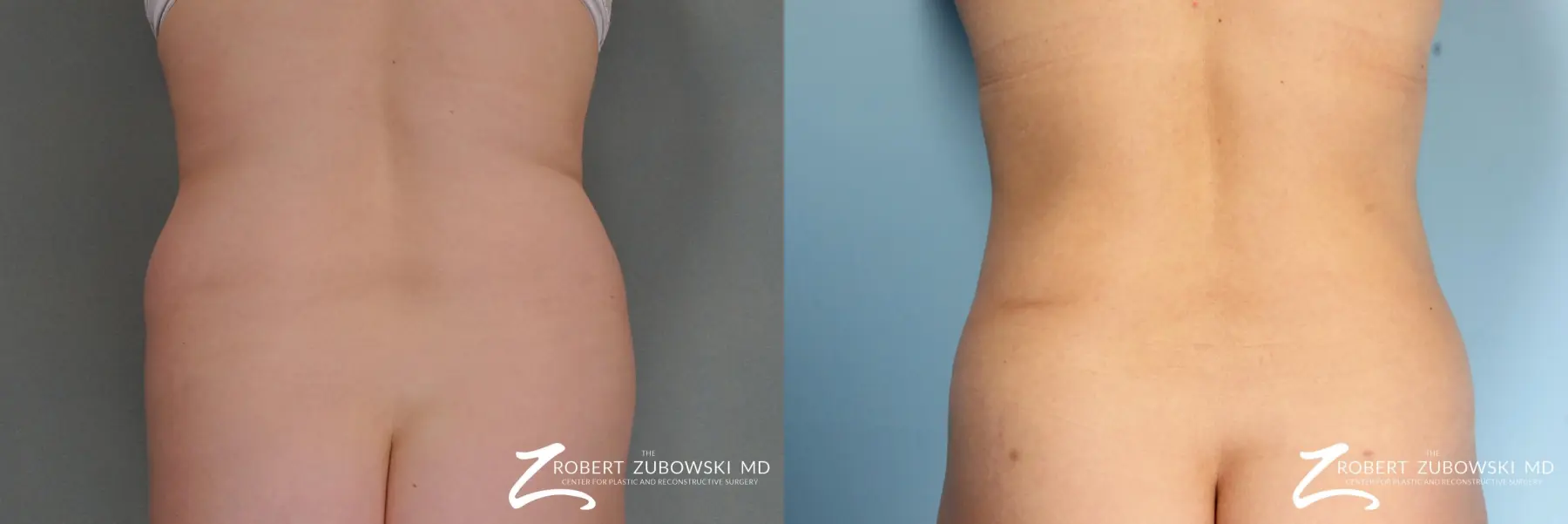 Liposuction: Patient 6 - Before and After 1