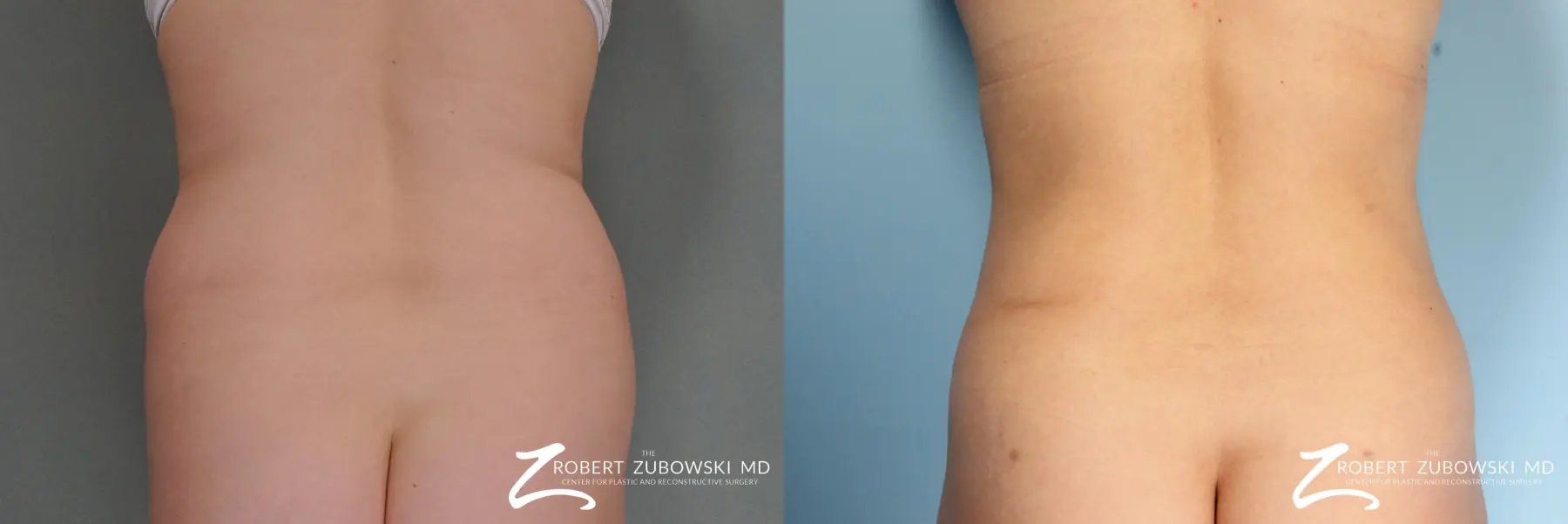 Liposuction: Patient 6 - Before and After  