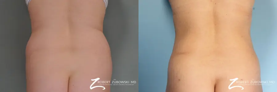 Liposuction: Patient 6 - Before and After 1
