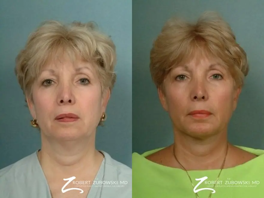 Liposuction: Patient 44 - Before and After  
