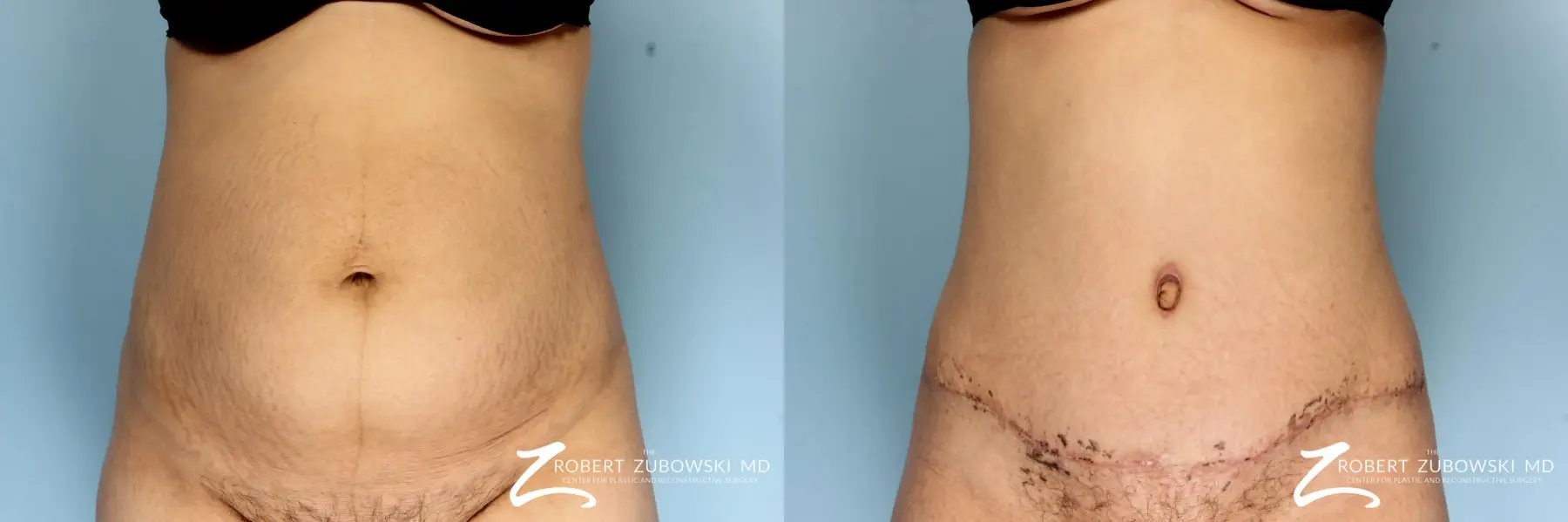 Liposuction: Patient 28 - Before and After  