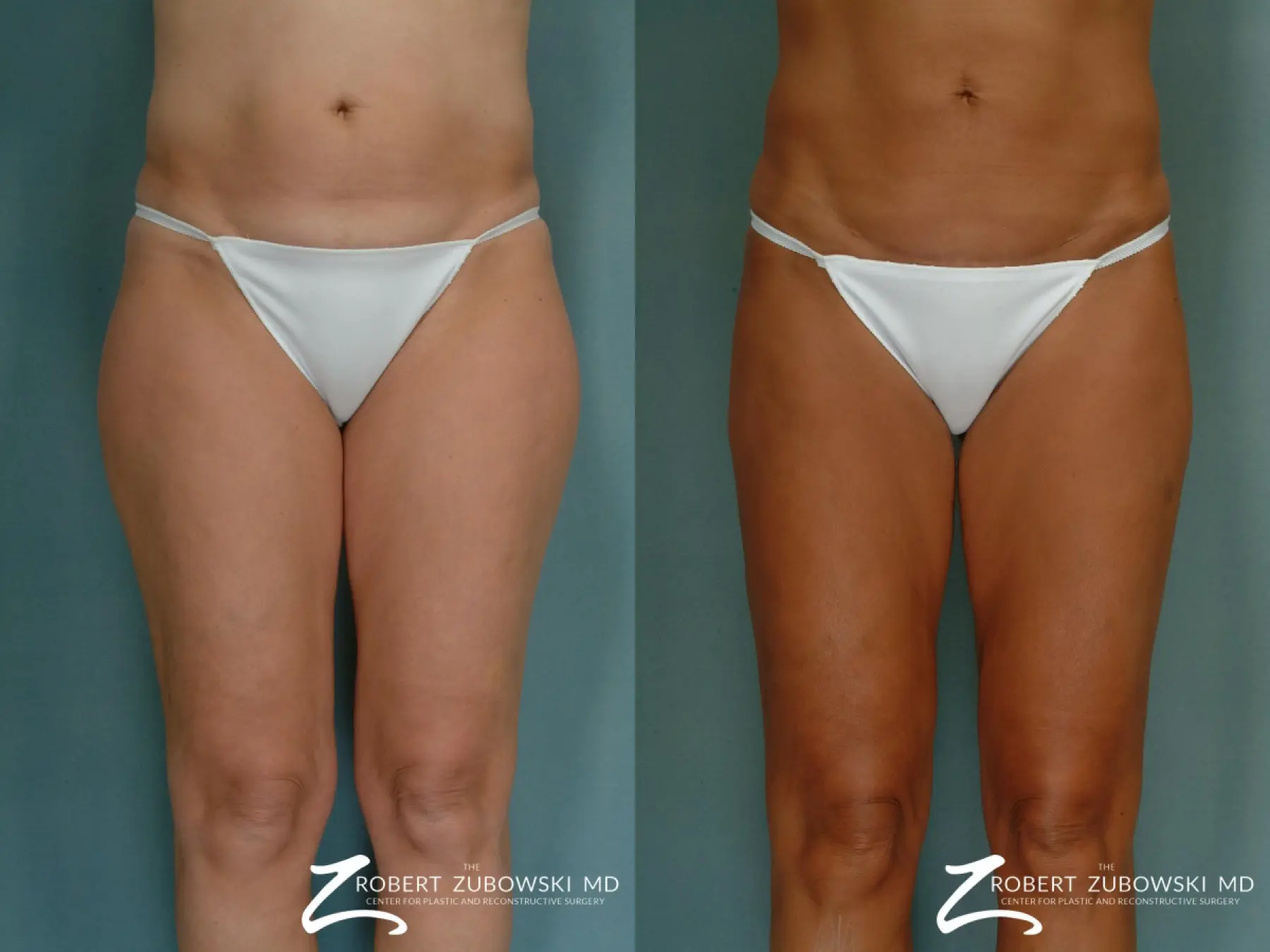 Liposuction: Patient 22 - Before and After 2