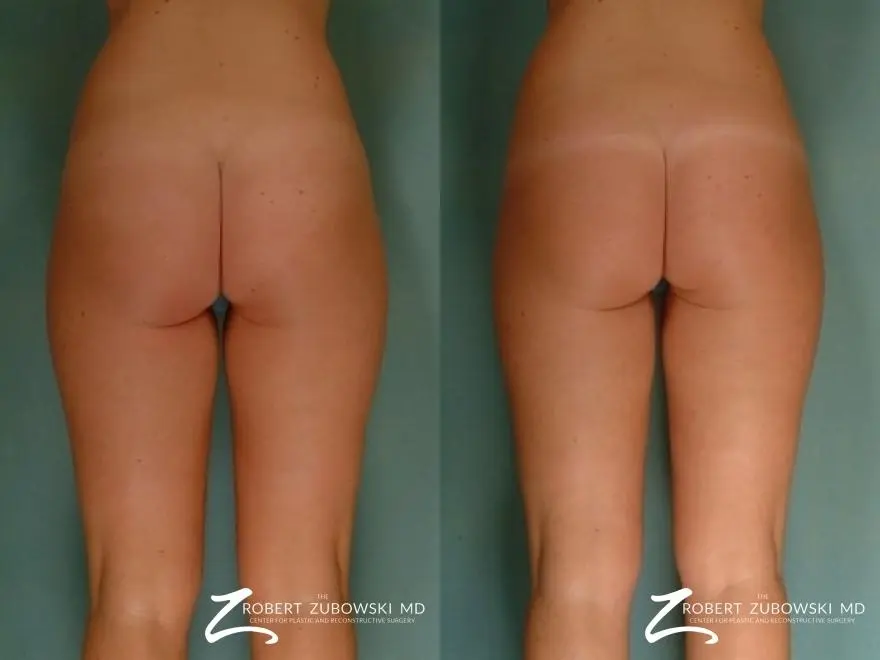 Liposuction: Patient 47 - Before and After 2