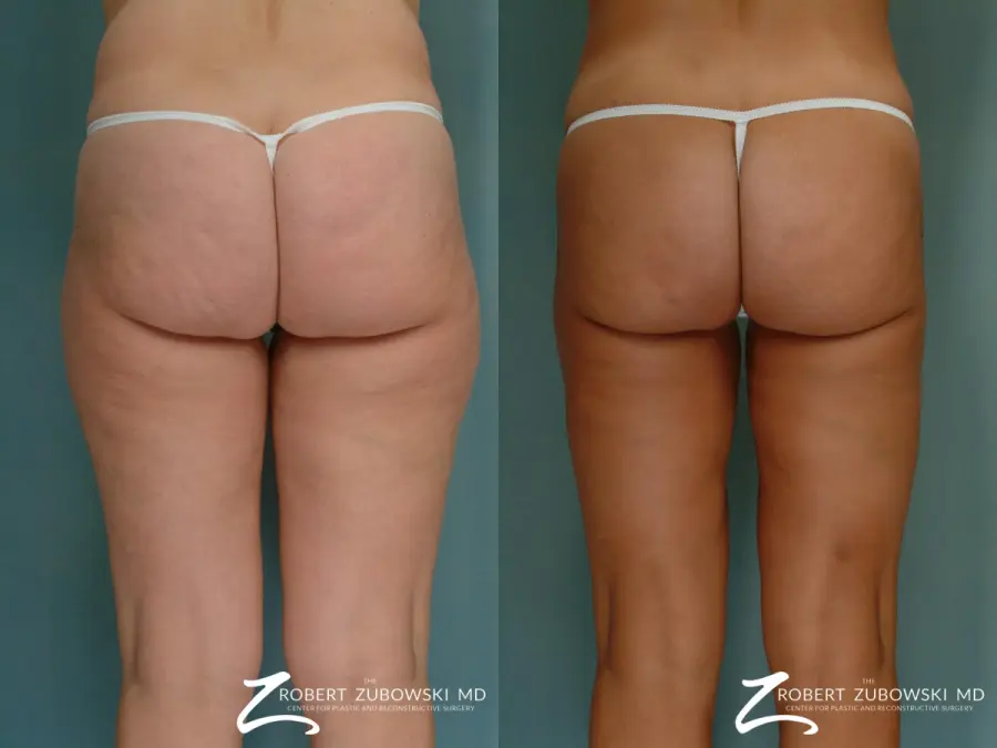 Liposuction: Patient 22 - Before and After 4