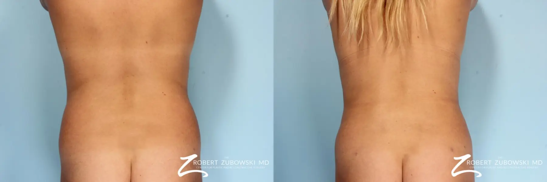 Liposuction: Patient 29 - Before and After  