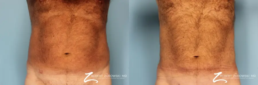 Liposuction: Patient 18 - Before and After  