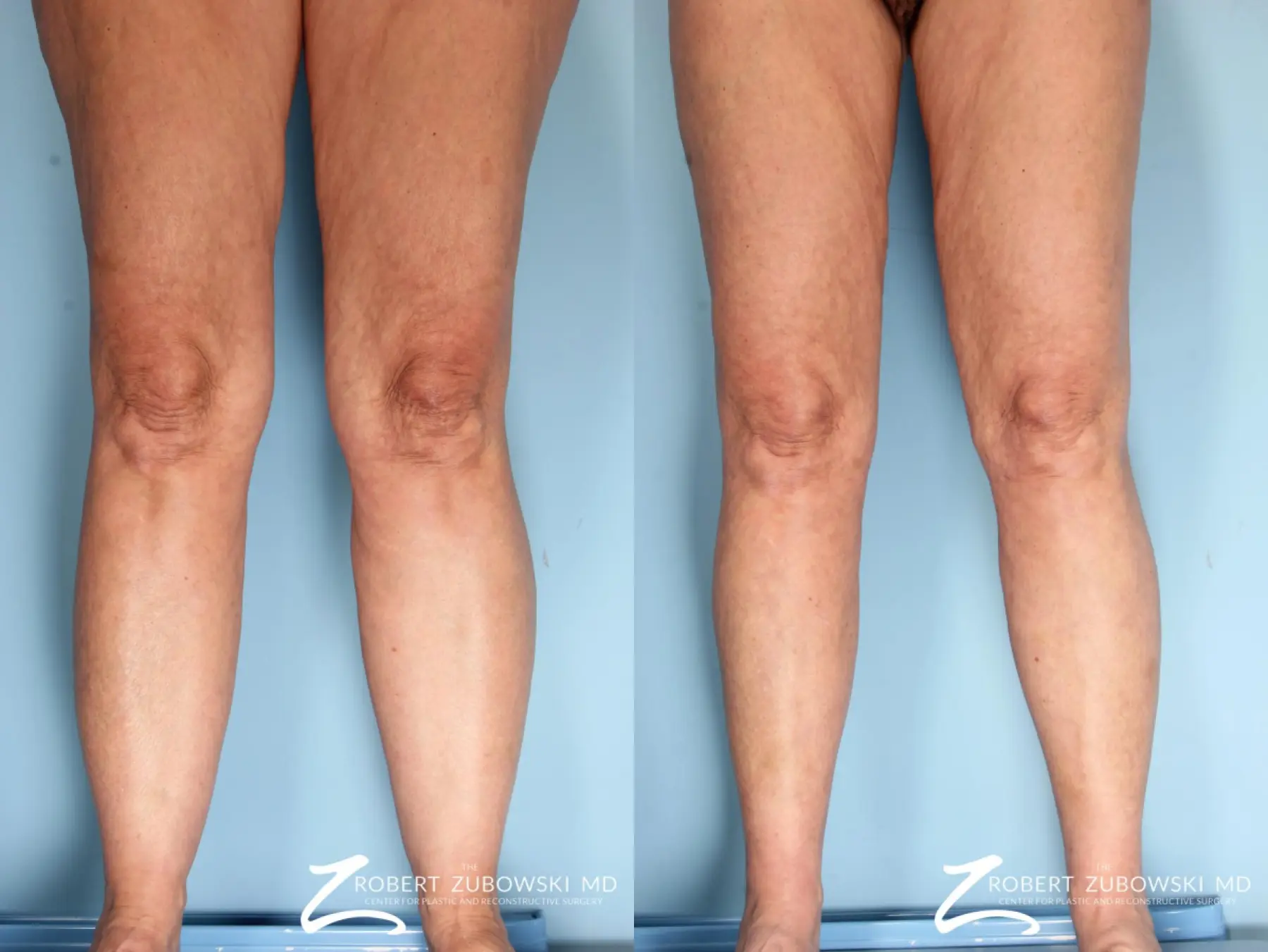 Liposuction Before After Photo Gallery