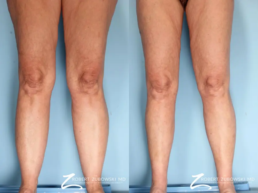 Liposuction: Patient 36 - Before and After 2