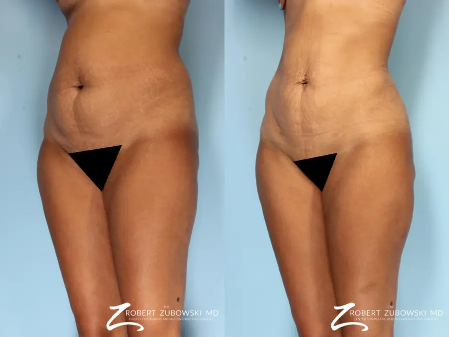 Liposuction: Patient 43 - Before and After 2