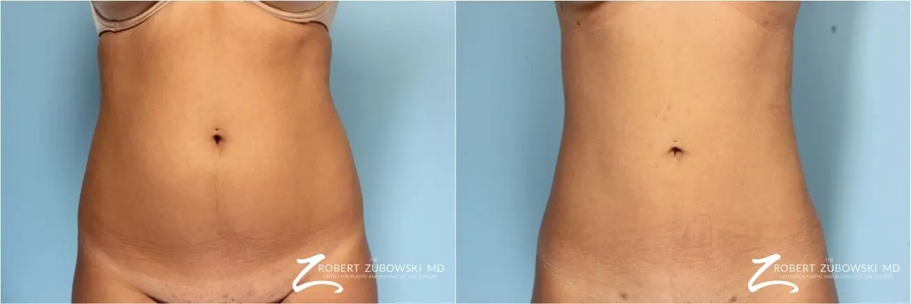 Liposuction: Patient 27 - Before and After 1