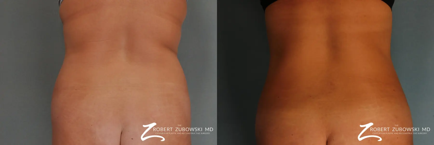 Liposuction: Patient 13 - Before and After  