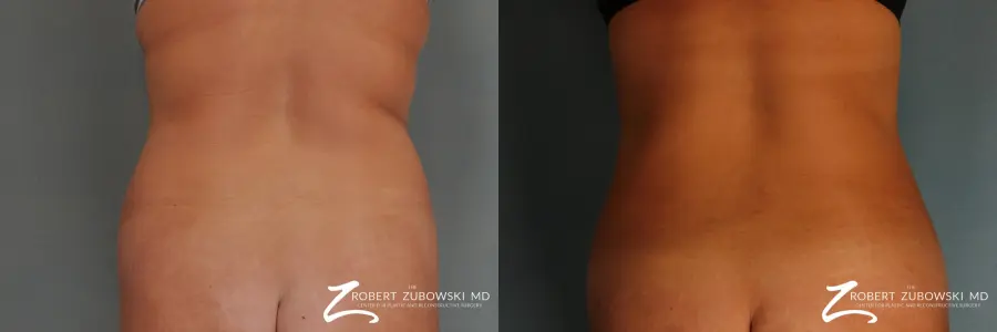Liposuction: Patient 20 - Before and After  