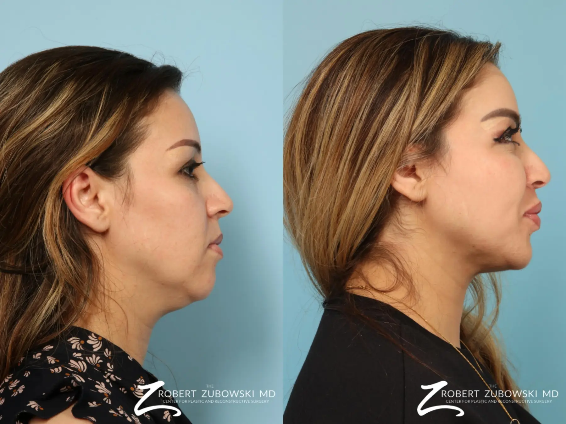 Liposuction Of The Neck: Patient 2 - Before and After 2