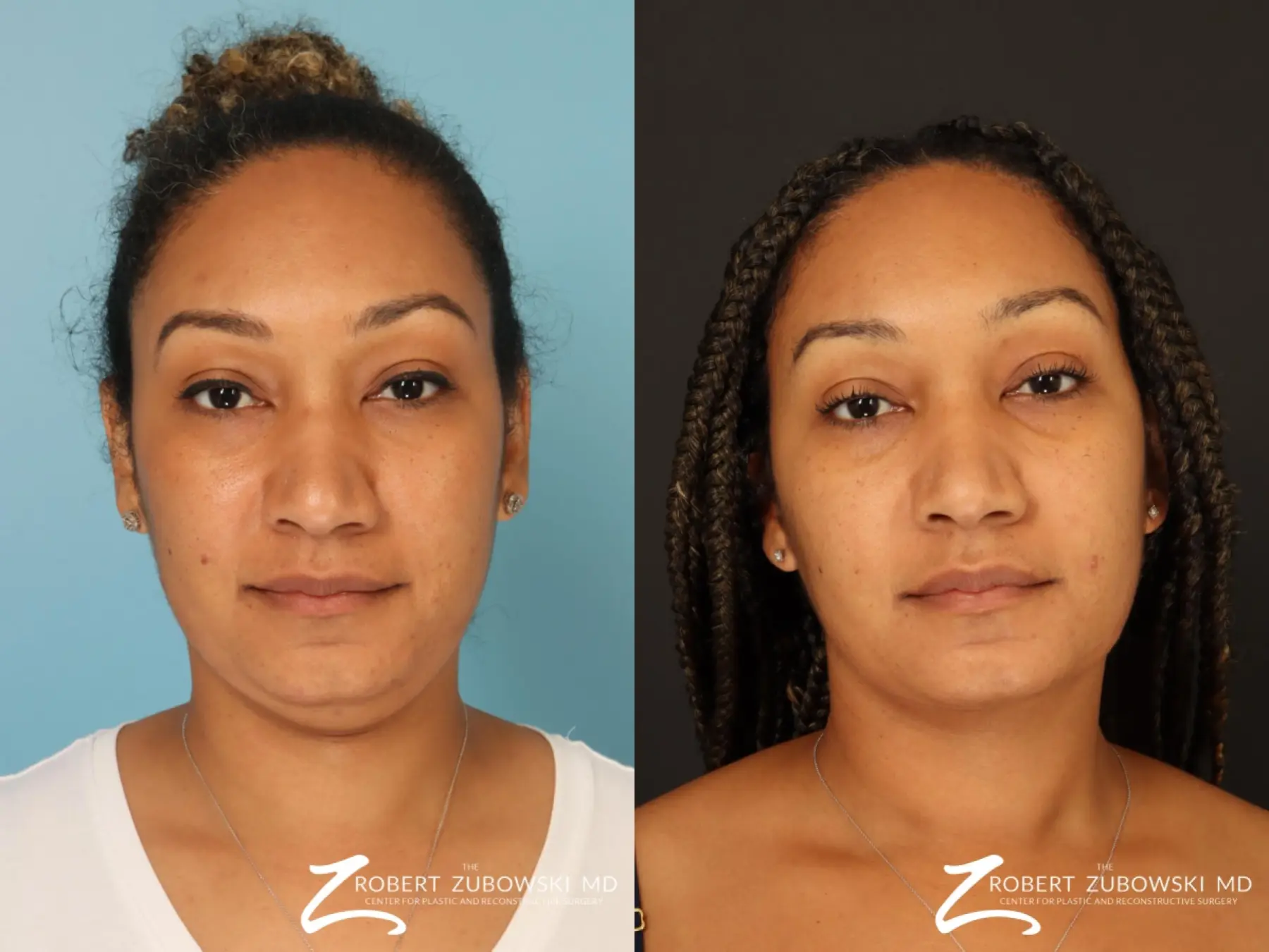 Liposuction Of The Neck: Patient 3 - Before and After  