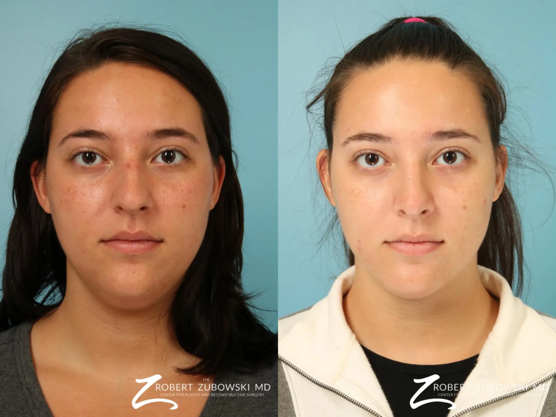 Liposuction Of The Neck: Patient 1 - Before and After  