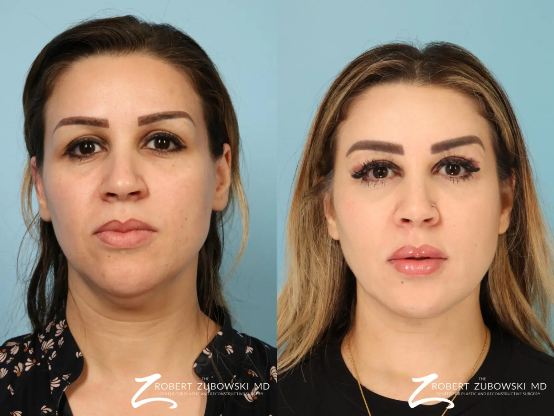 Liposuction Of The Neck: Patient 2 - Before and After  