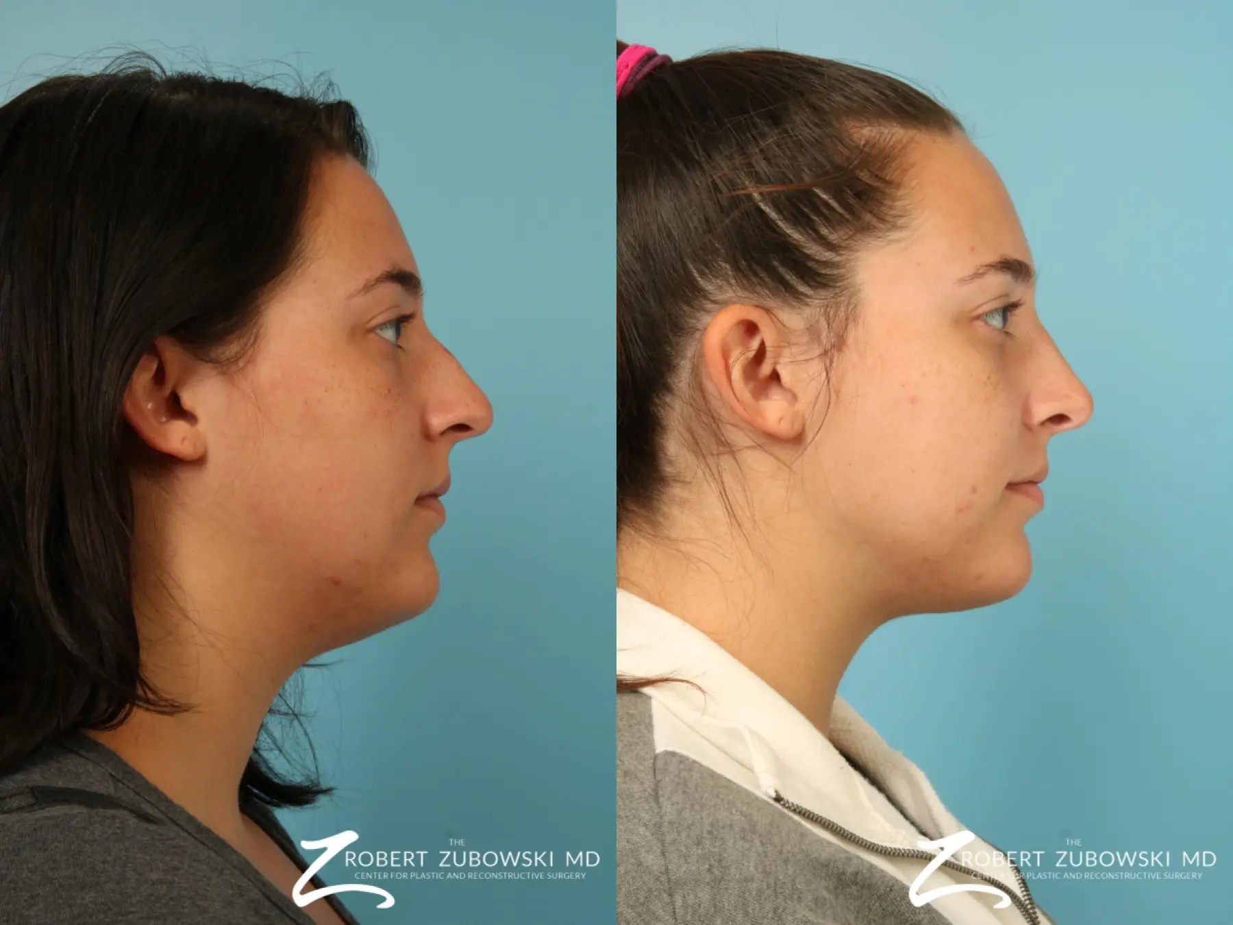 Liposuction Of The Neck: Patient 1 - Before and After 2