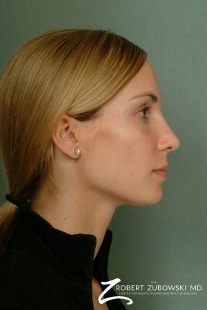 Rhinoplasty: Patient 4 - After Image 2